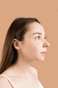 Picture of a girl with acne on her cheeks